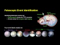 IPCAI2020 FetNet: A Recurrent Convolutional Network for Occlusion Identification in Fetoscopy Videos