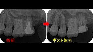 愛知県 歯内療法専門医【長いメタルポストの安全な外し方】（教育動画）