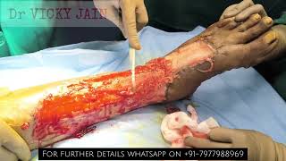 Diabetic Foot treatment | Skin grafting #diabetes #diabetesawareness #diabeticfootcare #diabeticfoot