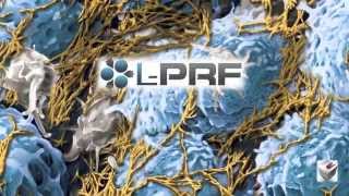 Why L-PRF (Leukocyte-Platelet Rich Fibrin)?