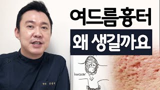 여드름흉터의 생성원리. 왜 패인흉터가 생길까요?  어븀에어셀 (흉터조각술+에어프락셀) 유현석 원장 Er:airxel=shouldering+airfraxel