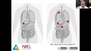 In this DocTalk on the Erasur Trial, the PIs, Drs. Hitchcock, Miller \u0026 Romesser discuss the trial