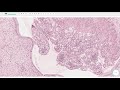 endocervical polyp uterine cervix histopathology