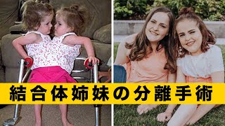 腹部結合の双生女児が、4歳で分離手術をして現在満20歳に