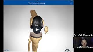 Total knee replacement, also known as total knee arthroplasty, is a surgical procedure commonly perf