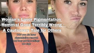 Woman Left with Severe Burns After Laser Pigmentation Removal Her Warning to Others