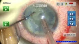 過熟白內障飛秒雷射手術 hypermature cataract with FLACS