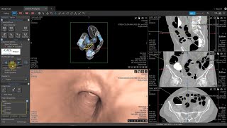 Vitrea Demonstrations  |  Colonography Update All Views