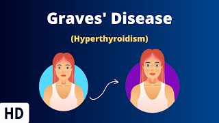 Graves' Disease: Everything You Need To Know