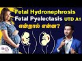 Fetal hydronephrosis | Fetal Pyelectasis | UTD A1 என்றால் என்ன? | Dr. Karthik Senthilvel | karu Scan