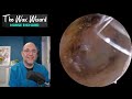 crushed in the ear 409 ear earwax earwaxremoval asmr satisfying foryou fyp foryourpage