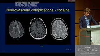 Neuro - Central nervous system changes after treatment   What you need to know 1