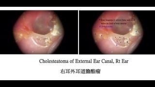 外耳道膽酯瘤 右耳( 更新版 )External Ear Canal Cholesteatoma, Rt ear_Update