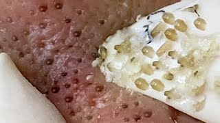 Relax every day with Apple Spa - Squeeze acne blackheads #28