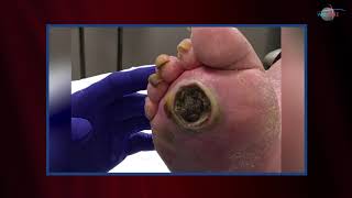 WCW: Debriding a Plantar Ulcer to Prevent Infection