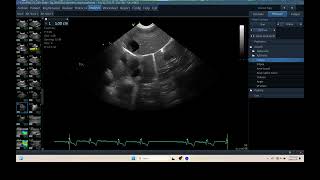 IQ 310 TFAST MEDIASTINAL LN ENLARGEMENT HEPATOMA ULTRASOUND ECHOPAC ANALYSIS 2