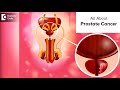 Prostate Cancer | Stages, Diagnosis & Tests Done in MEN - Dr. Girish Nelivigi | Doctors' Circle