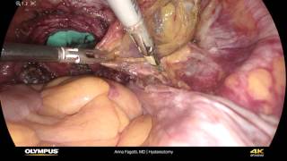 Hysterectomy Olympus 4K