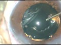 phacoemulsification of soft cataract