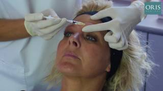 Botox Treatment for The Glabella Complex