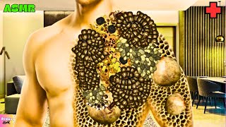 LIVE | HEAVY INFECTED  ASMR TREATMENT | REMOVE TRYPOPHOBIA ANIMATION  @relaxoasmrofficial