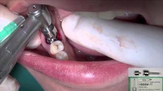 Same Day Dental Implants \u0026 Teeth - Implant, Lower Molar