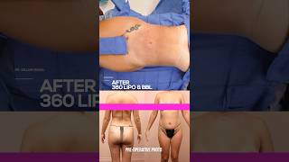360 Lipo & BBL | Incredible Results You Won't Believe!