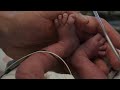 First Baby Born in US from Uterus Transplant