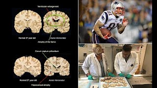 Aaron Hernandez's brain tissue showed severe memory damage