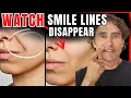 Nasolabial Folds DIY Hacks vs MedSpa Solutions