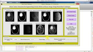 Brain Tumor Detection Using Watershed Technique Matlab Project with Source Code
