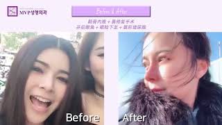 韩国MVP整形医院案例MVP PLASTIC SURGERY