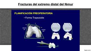 FRACTURA DE FEMUR DISTAL