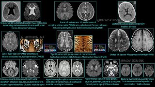 Pediatric Neuroradiology -Rare but classic cases (RBC) set III