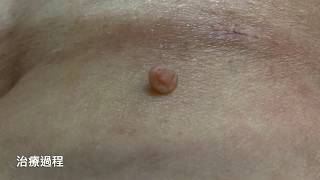 皮膚贅瘤，皮膚腫瘤切除 美麗新城診所莊禮謙醫師 skin tag removal