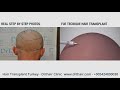 How to Make Hair Transplant    What is Hair Transplant Animation with voice