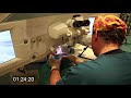 Real-time uncut unedited LASIK procedure live with real sound