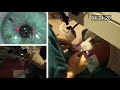 Real-time uncut unedited LASIK procedure live with real sound