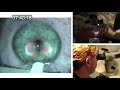 Real-time uncut unedited LASIK procedure live with real sound