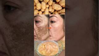 Potato Juice to remove skin pigmentation and dark spots #ashortaday #pigmentation #potato