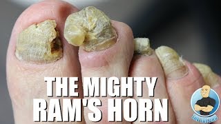 OVERGROWN RAM'S HORN TOENAIL REMOVAL