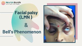 Bell’s Phenomenon & LMN Facial /Bell’s Palsy : Clinical features #LMNvsUMN #cranialnerveexam
