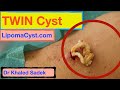 Twin Cyst Removal. Dr Khaled Sadek
