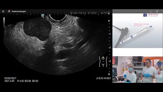 Experience with Medi-Globe SonoTip®  TopGain FNB needle