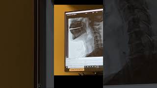 Lainey’s Modified Barium Swallow Study