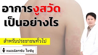 อาการงูสวัด เป็นอย่างไร (Herpes Zoster Symptom)