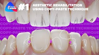 Aesthetic rehabilitation using Copy-Paste technique. #01