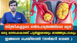 സ്ത്രീകളുടെ ഗർഭപാത്രത്തിലെ മുഴ  ഒരു മാസംകൊണ്ട് പൂർണ്ണമായും മാഞ്ഞുപോകും ഇങ്ങനെ ചെയ്താൽ Fibroids