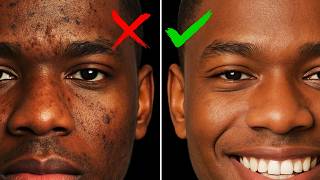 How to fix Hyperpigmentation (Science Based)