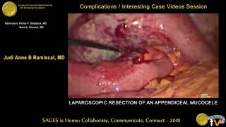 Laparoscopic resection of an appendiceal mucocele